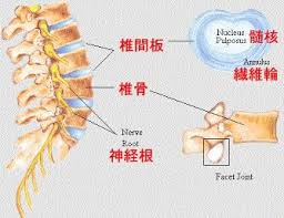 椎間板ヘルニア