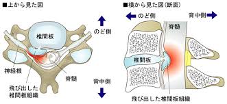 椎間板ヘルニア